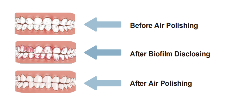 Air polisher-Air