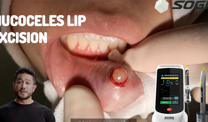 Periodontal sterilization