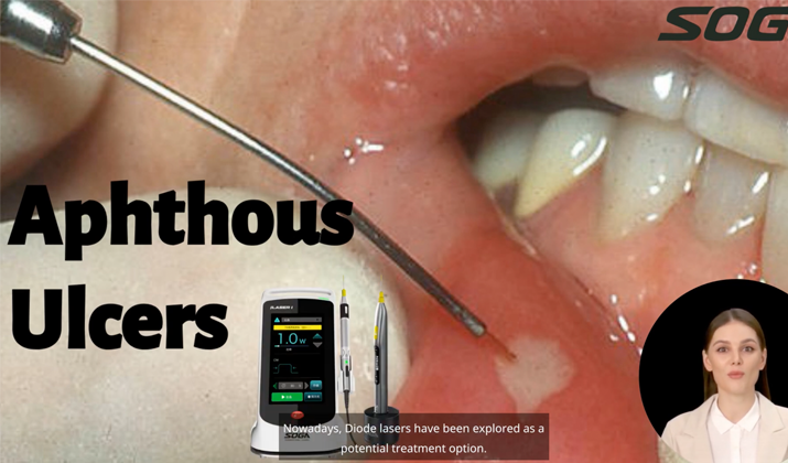 laser ulcer