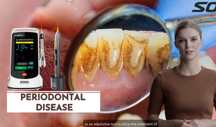 laser periodontitis