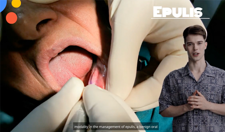 aser Gum tumors